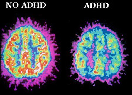 Good Intentions Won’t Cure ADHD